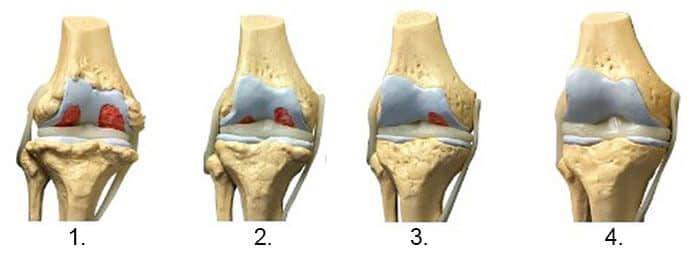 Artroza deformată a genunchiului tratament de 2 grade