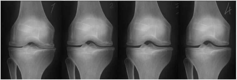 osteocondroză 2 grade ale tratamentului articulației genunchiului